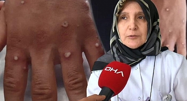 İstanbul'da maymun çiçeği virüsü paniği!